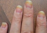 Fingernail Fungus from Cigarette Smoking