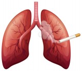 Cigarette Smoke Can Cause Lung Cancer